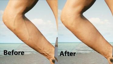 Male V - Removal of vein in arm