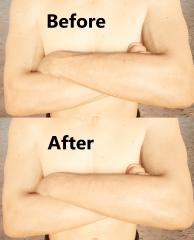 Male V - Removal of vein in arm