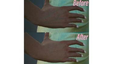 Subtle skin appearance changes in Fem V