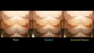 Top surgical scars